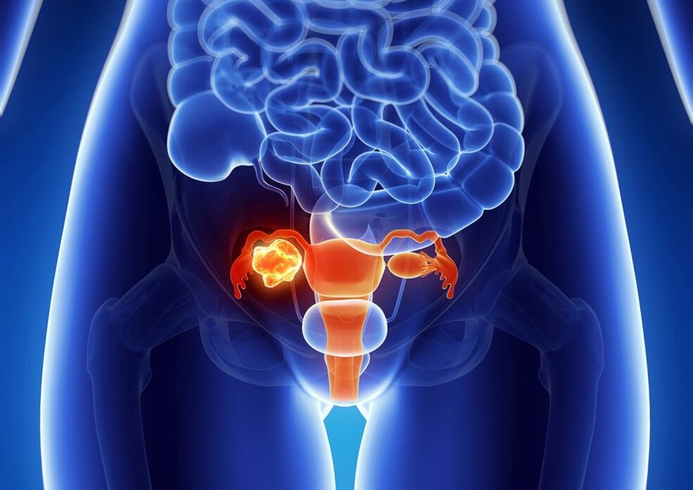 Woman's ovarian pathology under the influence of alcohol